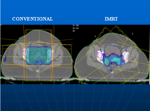 Intensity Modulated Radiation Therapy